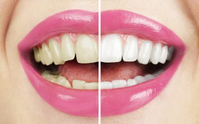 The 7 Best Ways to Whiten Teeth Fast
